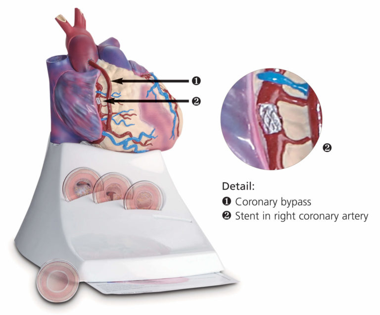 Life Size Diseased Heart Model | Scientific Publishing